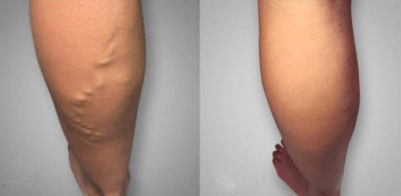 Varixil Forte - Najlepsza Cena dla Zdrowia Twoich Naczyń in Poland